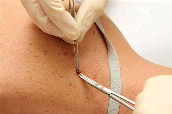 oncologia-cutanea-sondrio-milano-monza-02 oncologia-cutanea-sondrio-milano-monza morbegno