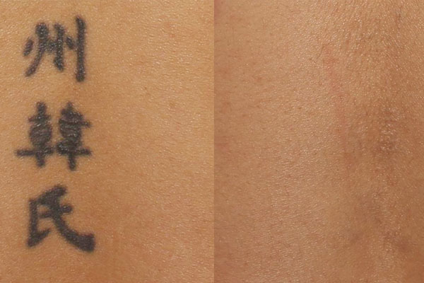 rimozione-tatuaggi-sondrio-milano-monza-01