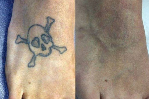 rimozione-tatuaggi-sondrio-milano-monza-02