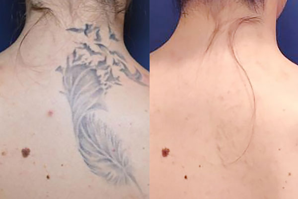 rimozione-tatuaggi-sondrio-milano-monza-03