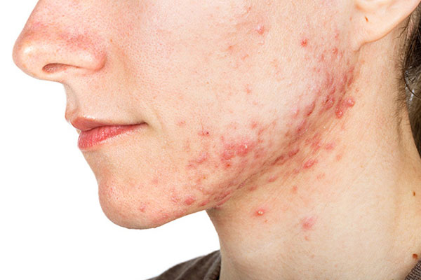 trattamento-acne-sondrio-milano-monza-01