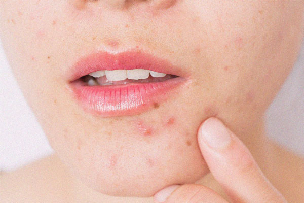 trattamento-acne-sondrio-milano-monza-02
