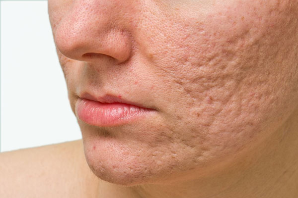 trattamento-acne-sondrio-milano-monza-03