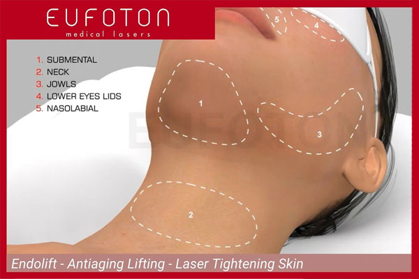 endolift-lifting-laser-viso-sondrio-milano-monza-03